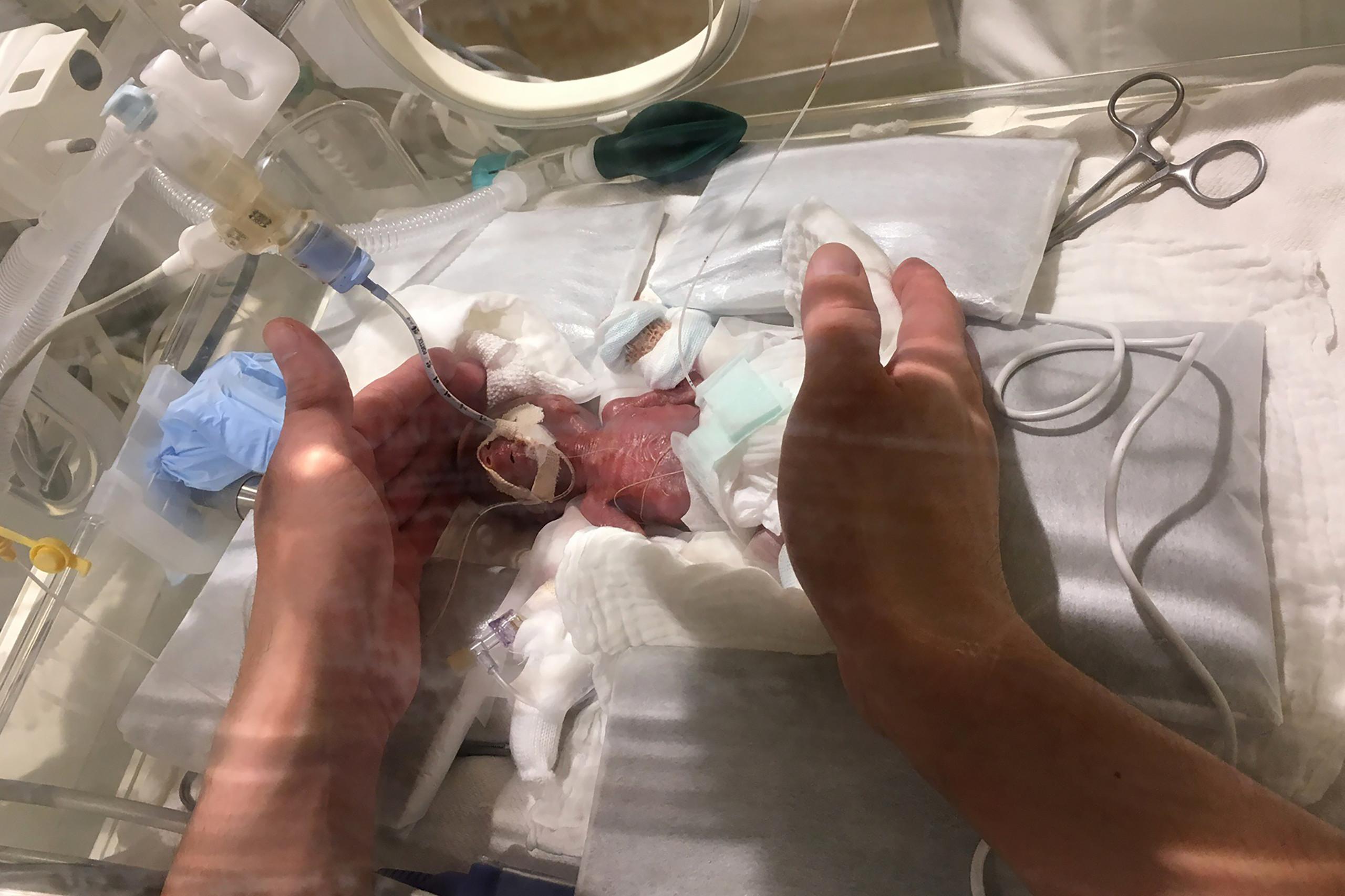 بوزن بصلة.. "أصغر طفل في العالم" يخرج من المستشفى