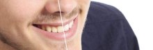 دراسة صادمة.. "تبييض الأسنان" أخطر مما تتصور